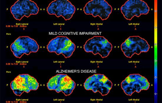 Diagnosis of alzheimer's disease
